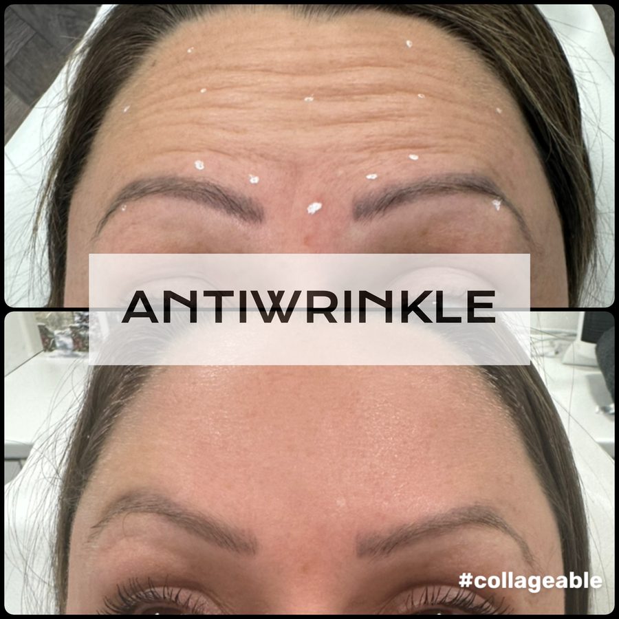 Anti-wrinkle treatment before and after — Hybridity Aesthetics