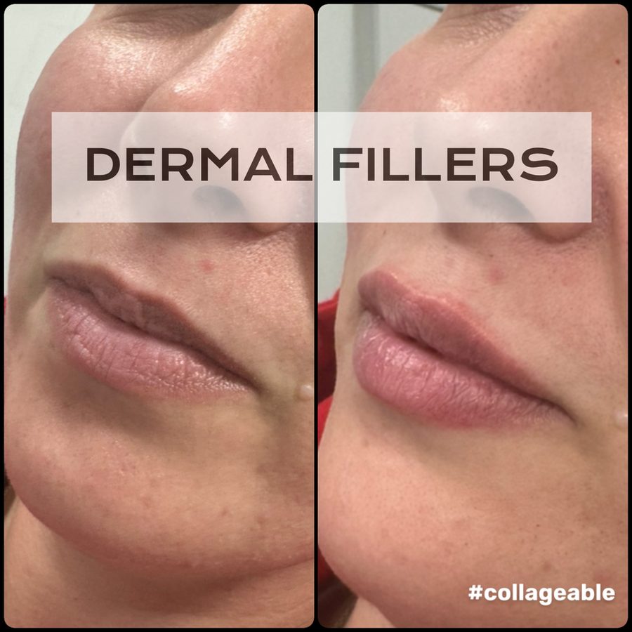 Dermal filler before and after — Hybridity Aesthetics
