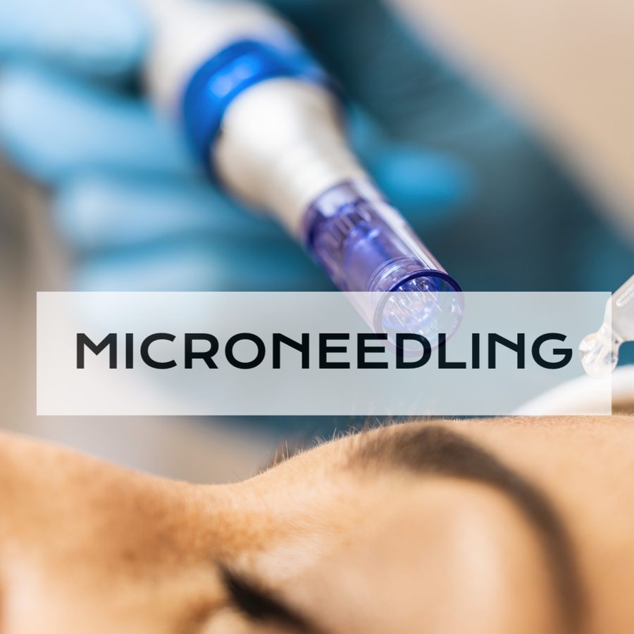 Microneedling treatment — Hybridity Aesthetics