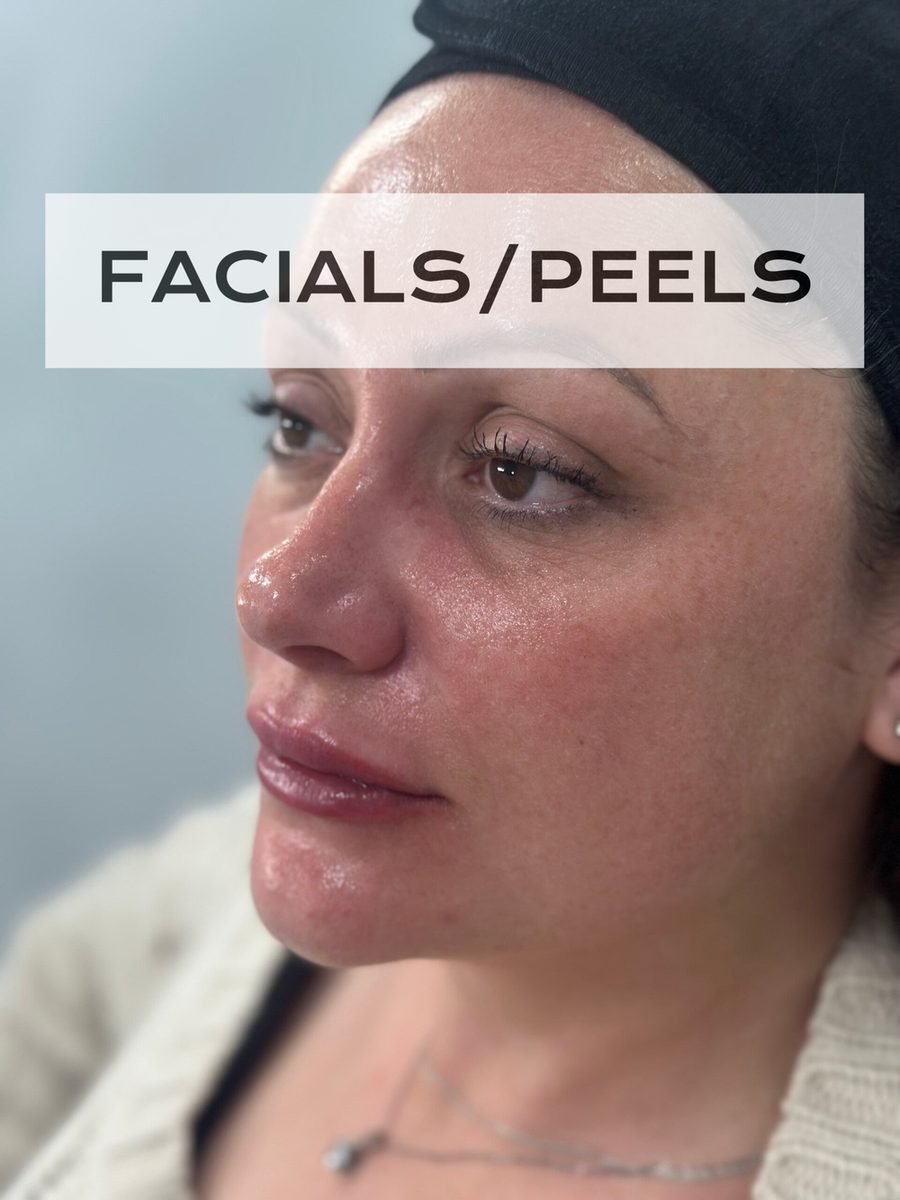 PCA Skin facial and peel result — Hybridity Aesthetics
