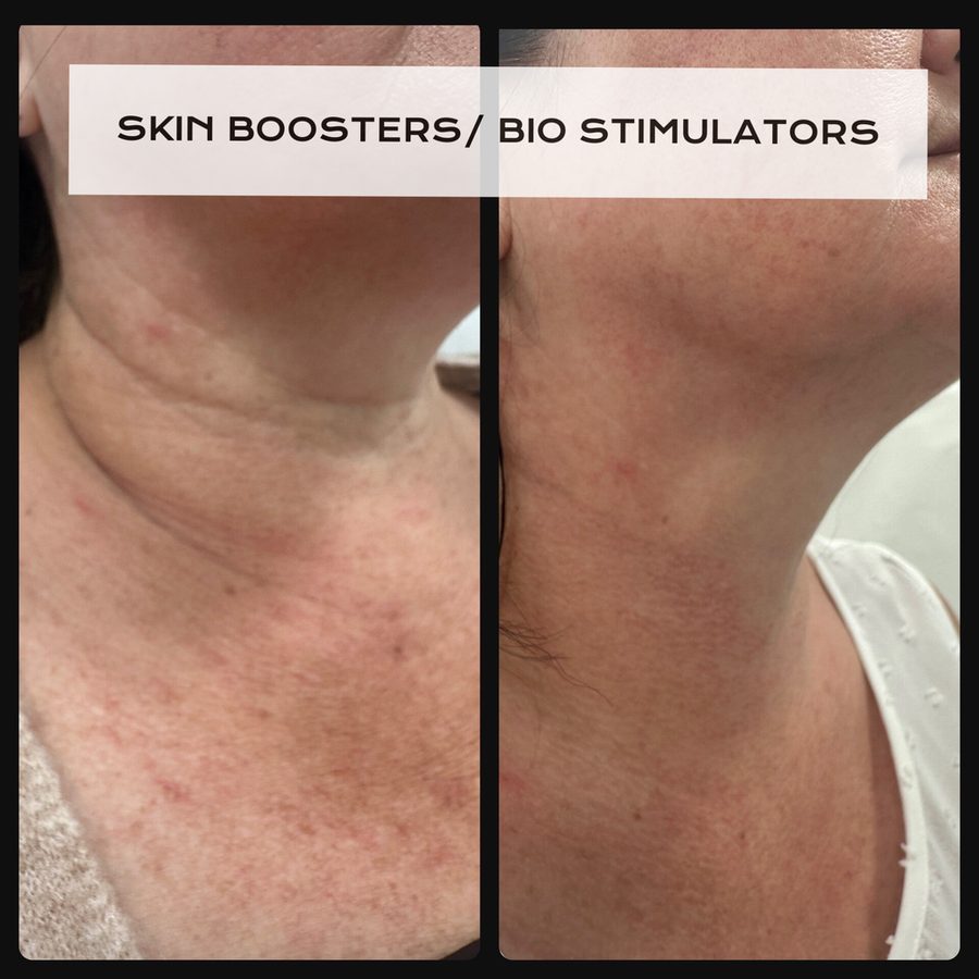 Skin boosters and biostimulators before and after — Hybridity Aesthetics